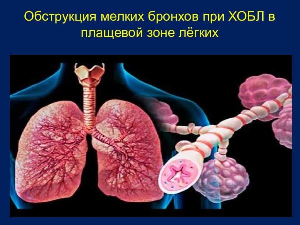 Роническая обструктивная болезнь лёгких