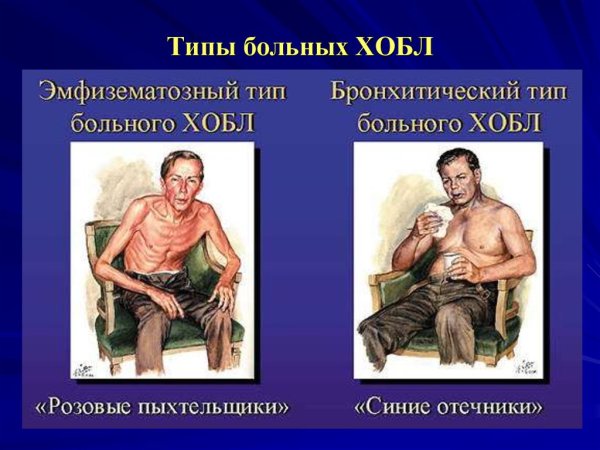 Бронхитический Тип ХОБЛ пыхтельщики