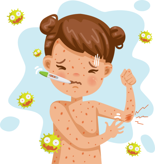 Обезьянья оспа и ветряная оспа