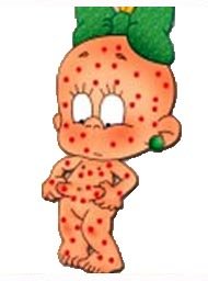 Ветряная оспа карантин в детском саду