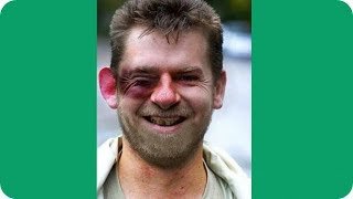 Человек в гипсе карикатура