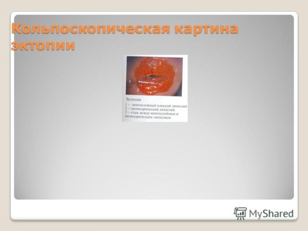 Шейка матки ацетобелый эпителий