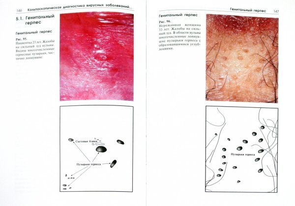 Схема кольпоскопии