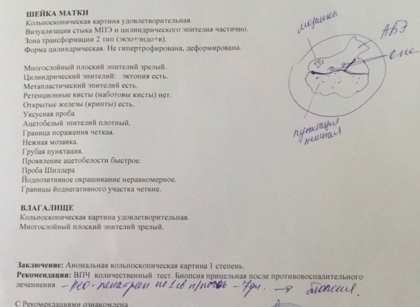 Кольпоскопия нормальное заключение
