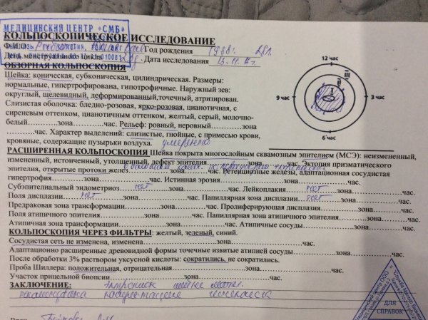 Кольпоскопия заключение эрозия шейки матки