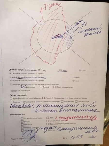 Аномальная кольпоскопическая картина 1