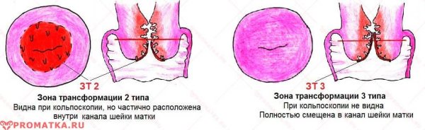 Результат кольпоскопии Абэ