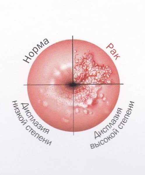Международная классификация кольпоскопических терминов