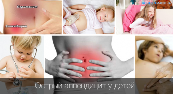 Острый аппендицит у детей