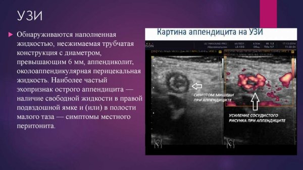 Флегмонозный аппендицит УЗИ