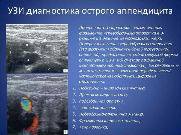 УЗИ признаки аппендицита