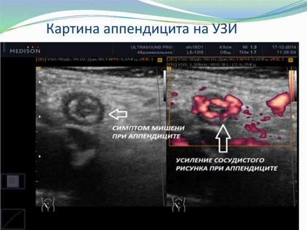 Аппендикулярный отросток на УЗИ