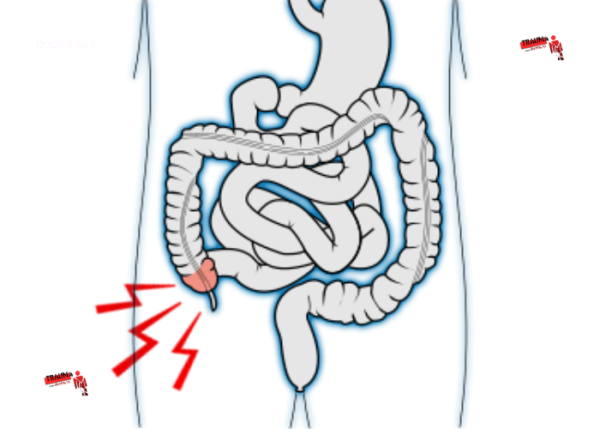Аппендикулярный перитонит