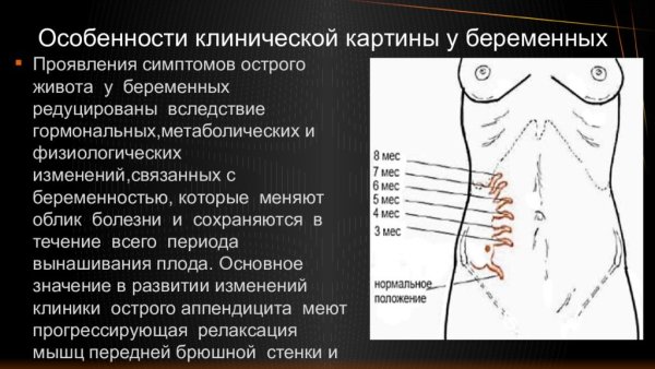 Острый аппендицит клинические рекомендации