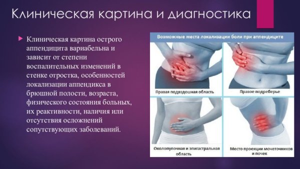 Осложнения аппендицита