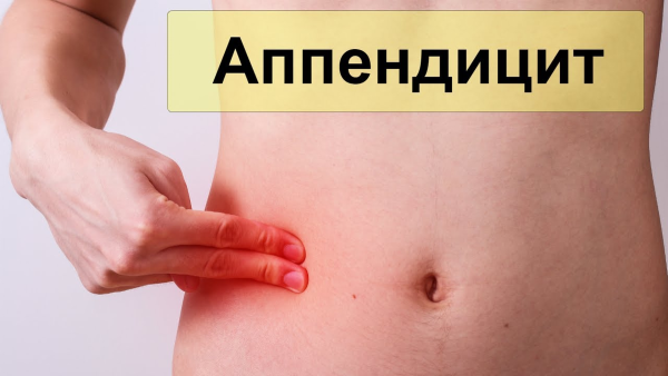 Острый аппендицит клиника