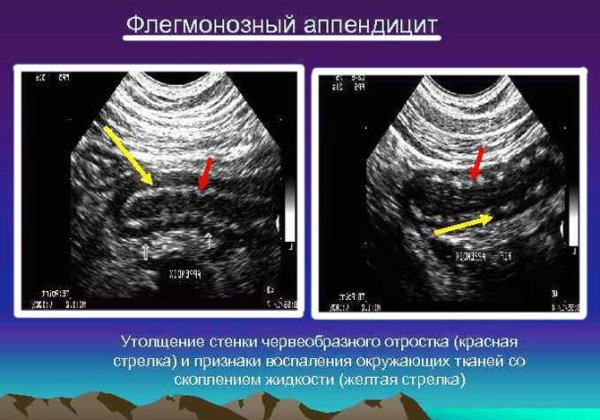 Воспаление аппендикса симптомы