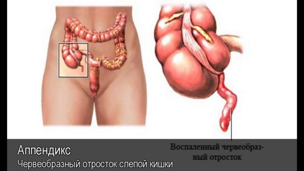 Симптомы острого аппендицита Раздольского