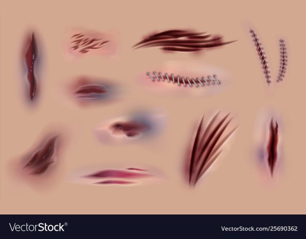 Скарификация шрамирование