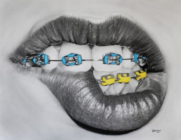 Брекеты нарисованные
