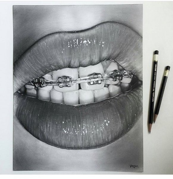 Картина зубы с брекетами