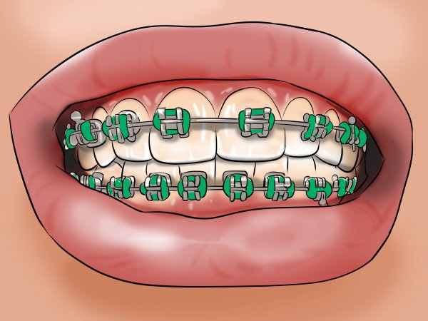 Брекеты рисунок