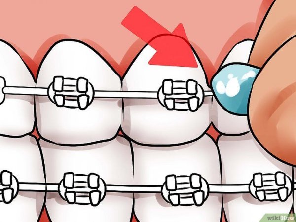 Воск для брекетов