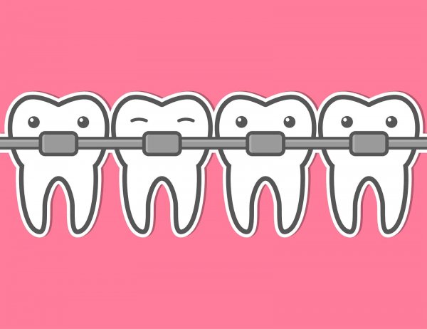 Брекеты нарисованные