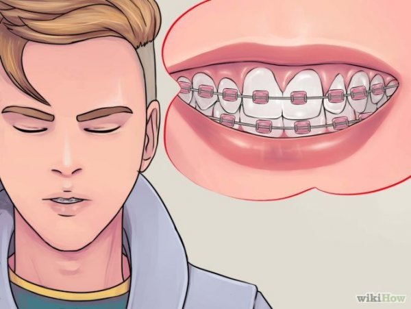 Арты с брекетами