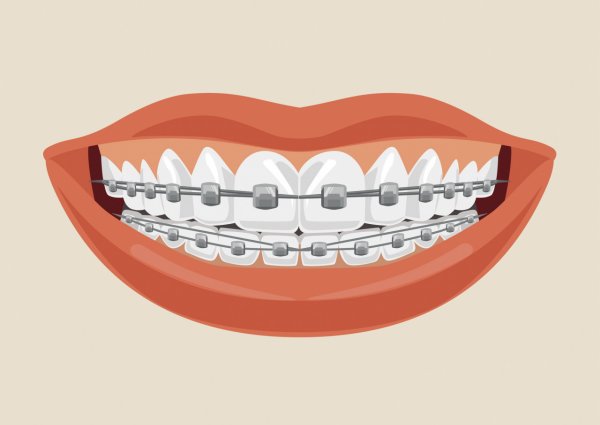 Зубы с брекетами вектор