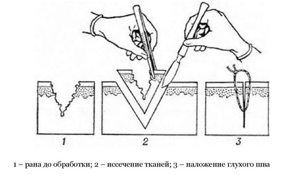 Наложение жгута закрутки на голень