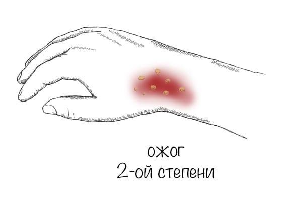 Оказание первой помощи при ожогов