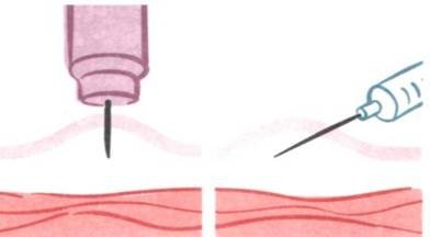Подкожная инъекция под углом 45