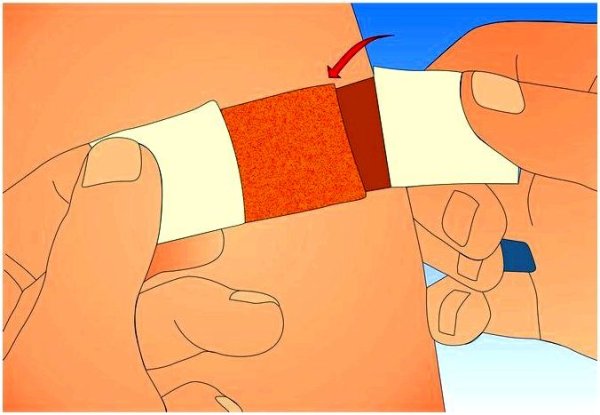 Антиожоговый пластырь