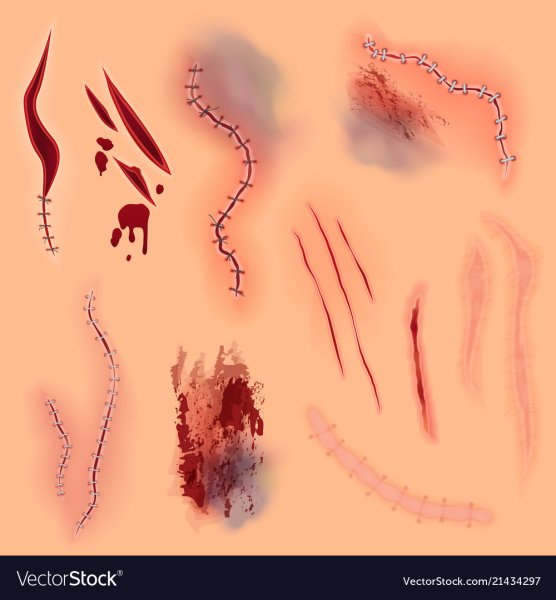 Техника наложения и снятия швов