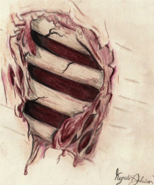 Наложение кровоостанавливающего жгута схема