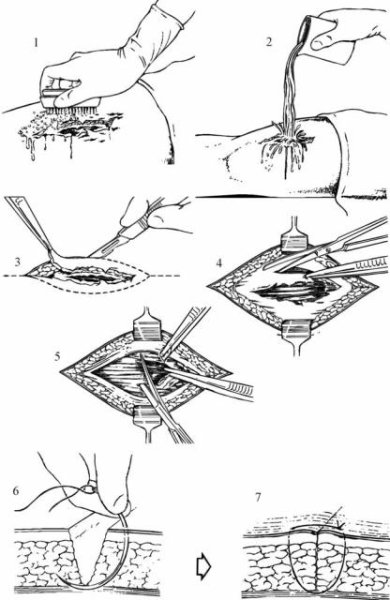 Пхо огнестрельной раны этапы