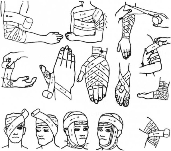 ПМП голени при переломе наложение шины