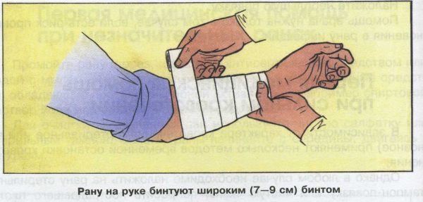 Портняжный шов хирургия