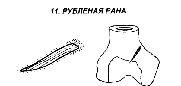 Транспортная иммобилизация при артериальном кровотечении