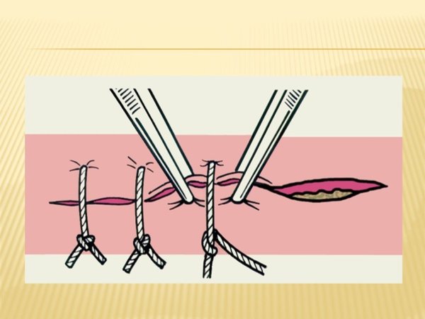 Воздействие соли на рану