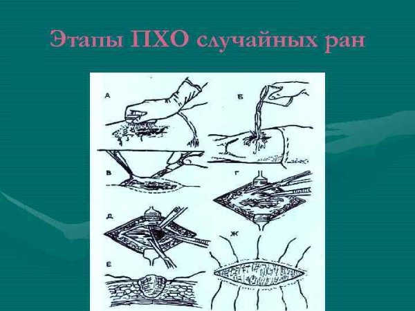 Огнестрельная рана рисунок