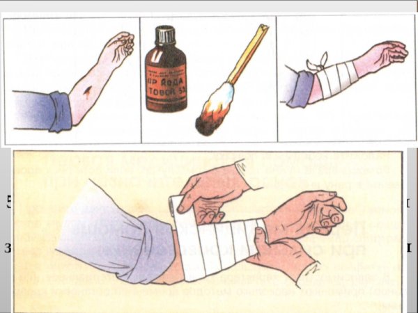 Провизорный шов по Донати