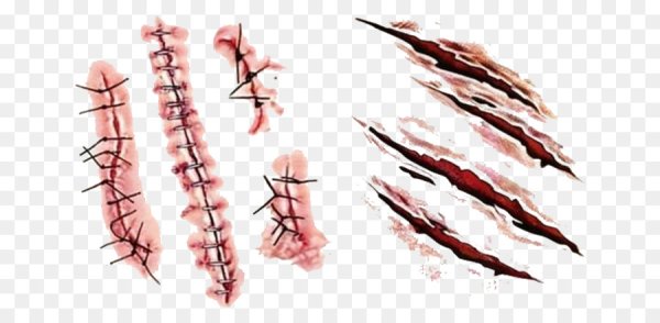 Перевязка раны алгоритм