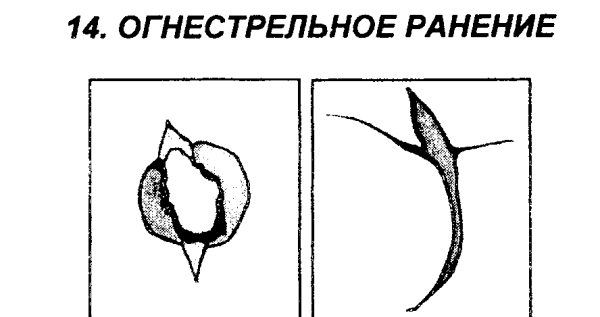 Защита раны от инфицирования