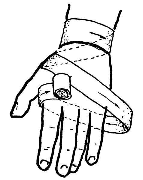 Остановка кровотечения наложение жгута закрутки