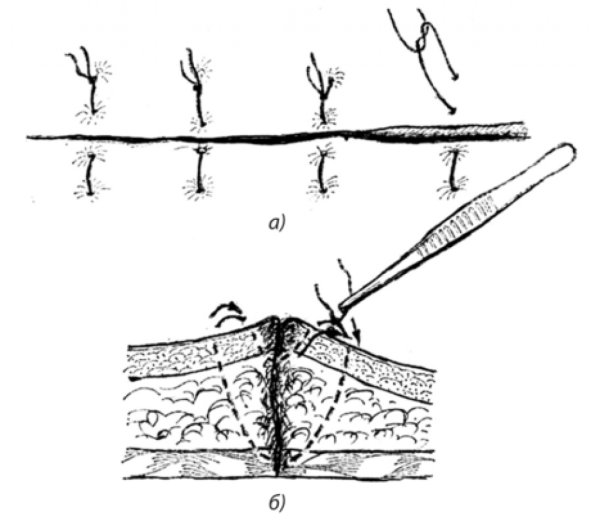 Механическая антисептика туалет раны