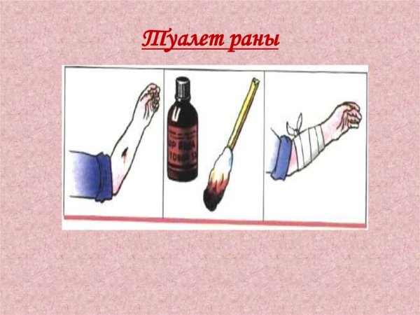 Остановка артериального кровотечения с помощью жгута