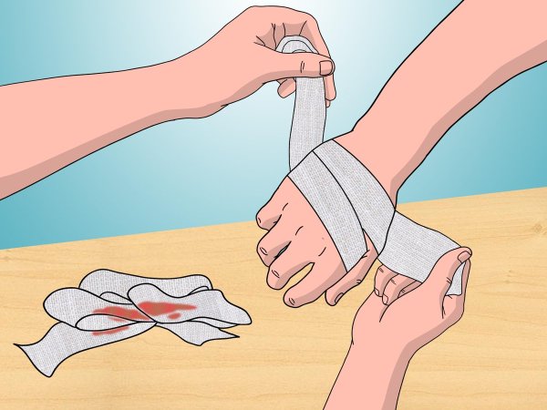 Кровотечения оказание помощи