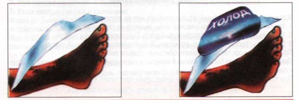 Термические ожоги классификация